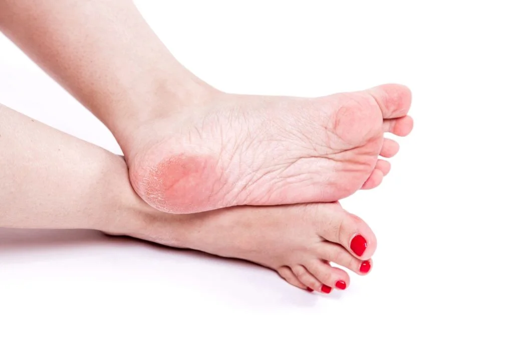 Close-up of feet with dry, thickened skin on the heel.