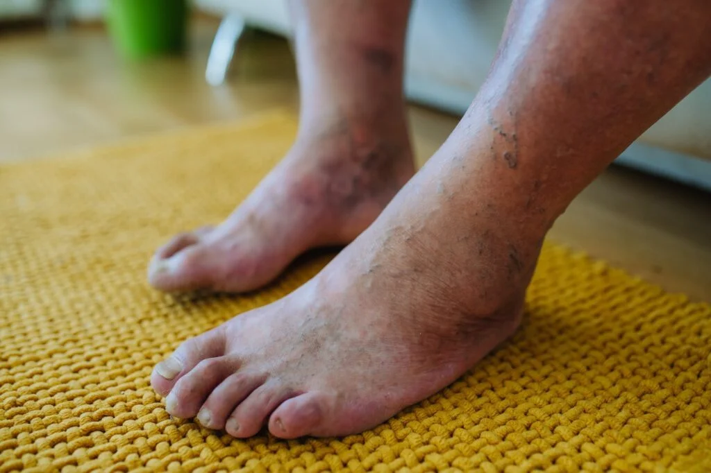 Close-up of swollen feet.