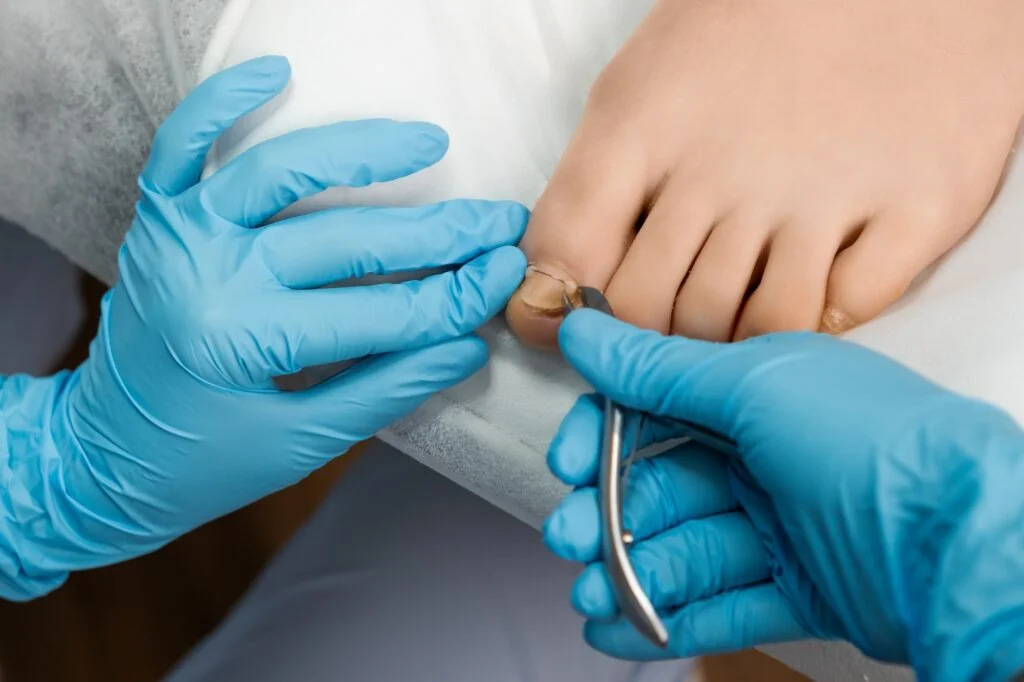 Doctor treating an ingrown toenail
