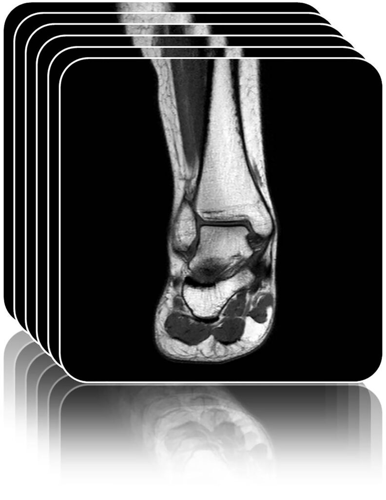 Foot MRI