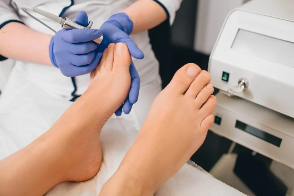 Podiatrist using a medical device to treat a fungal toenail