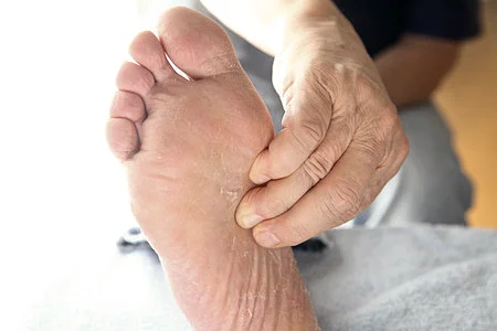 Person pressing the arch of the foot due to pain from high arches